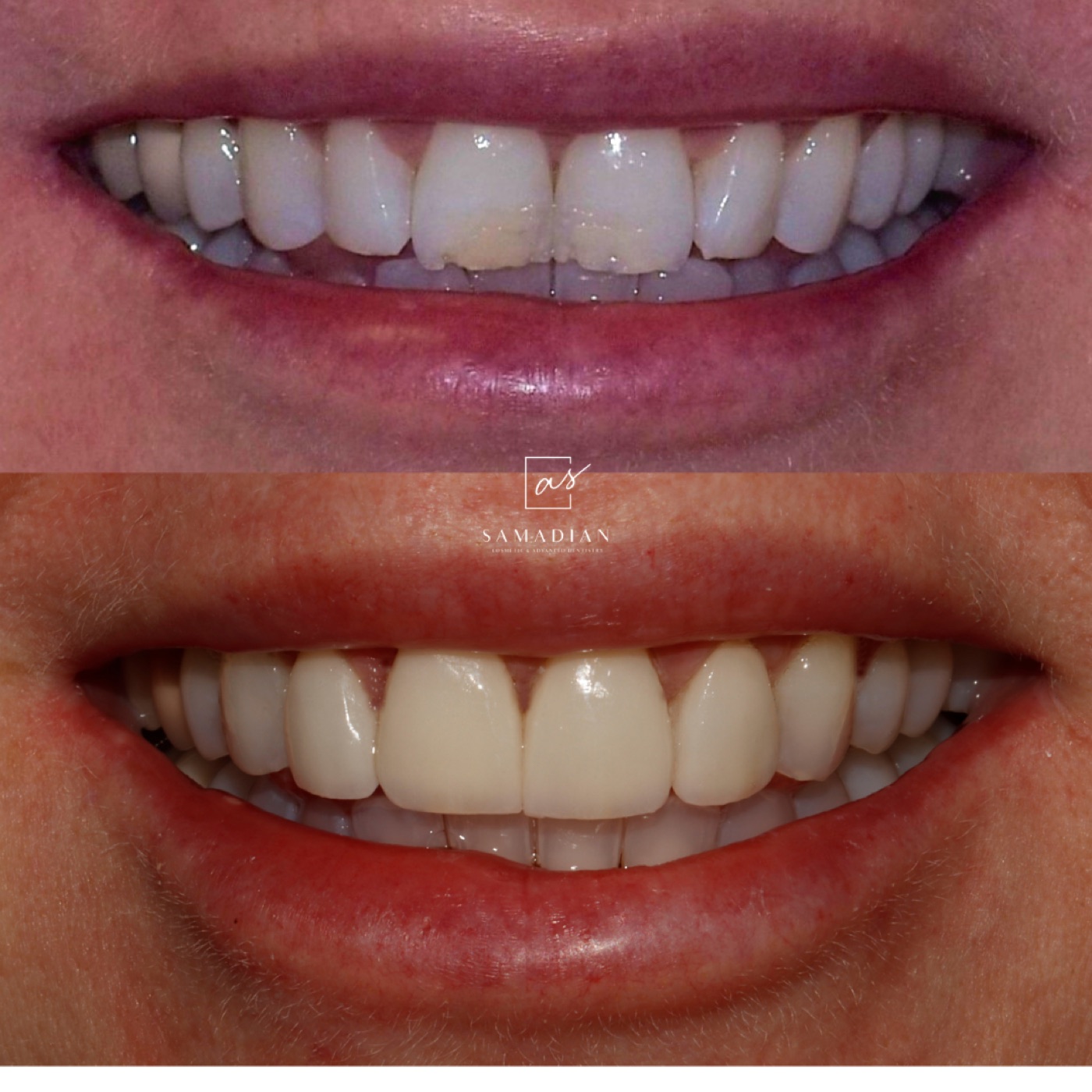 Porcelain veneers before and after - San Francisco patient