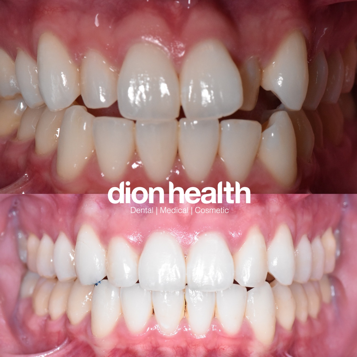 Porcelain veneers before and after - San Francisco patient