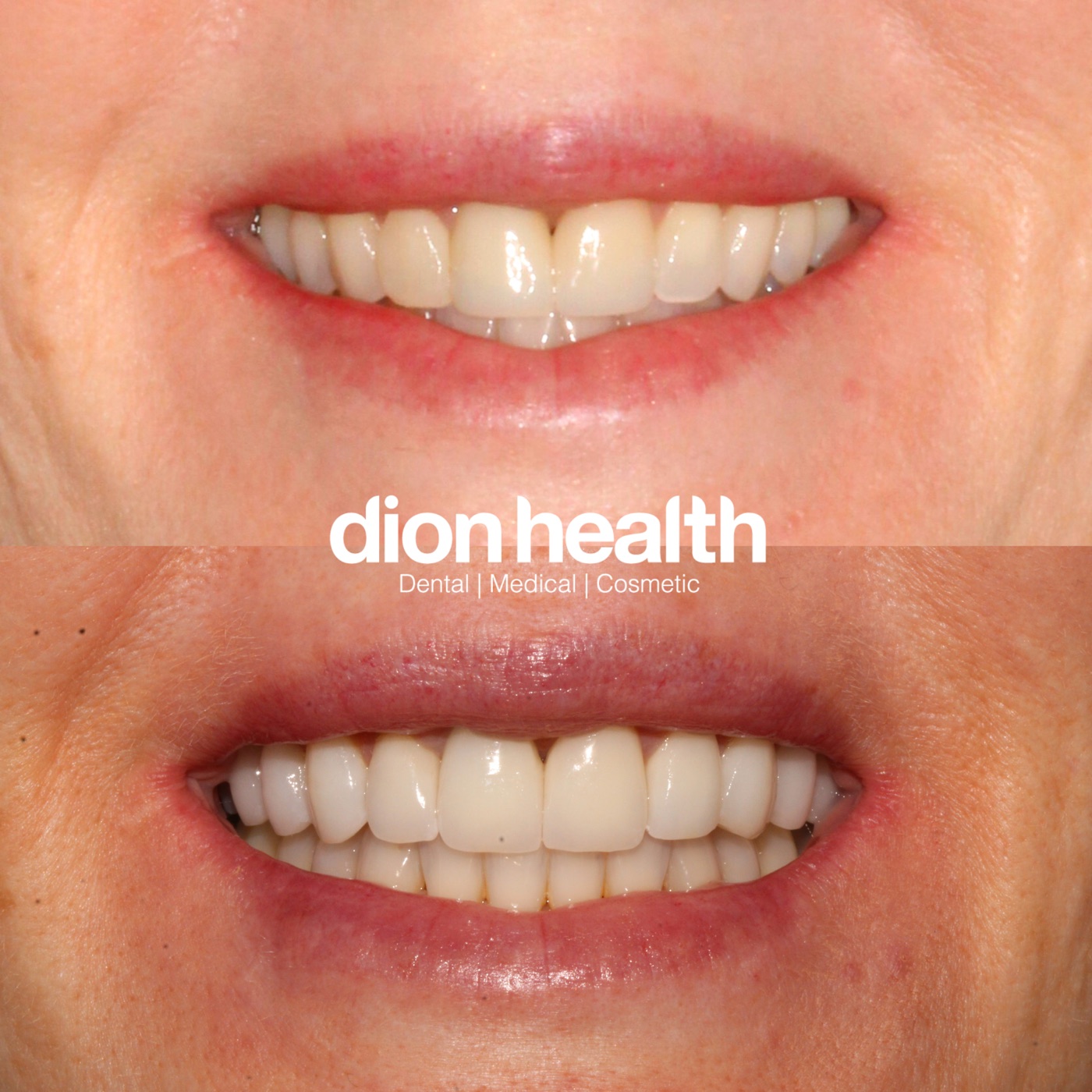 Porcelain veneers before and after - San Francisco patient