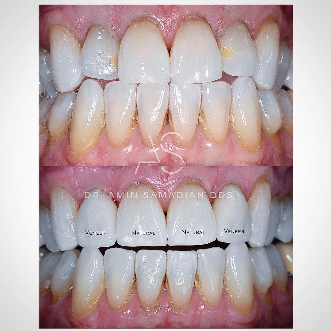 Veneers Before & After Gallery - Patient 56175439 - Image 1